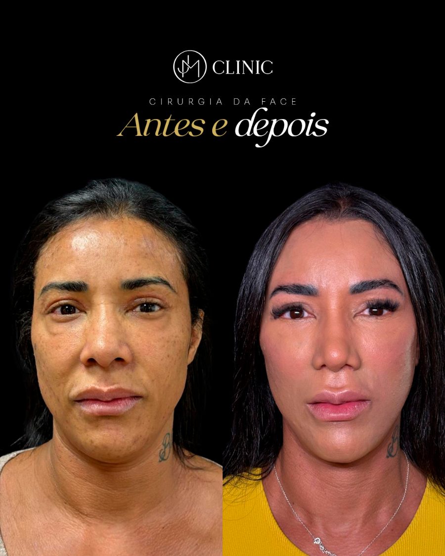 Antes e depois de cirurgia da face, JM Clinic