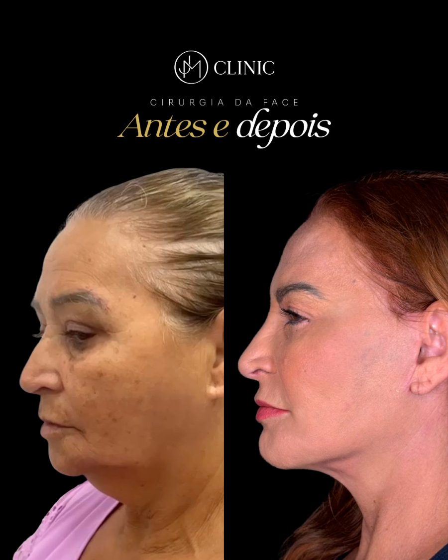 Antes e depois de cirurgia da face, JM Clinic