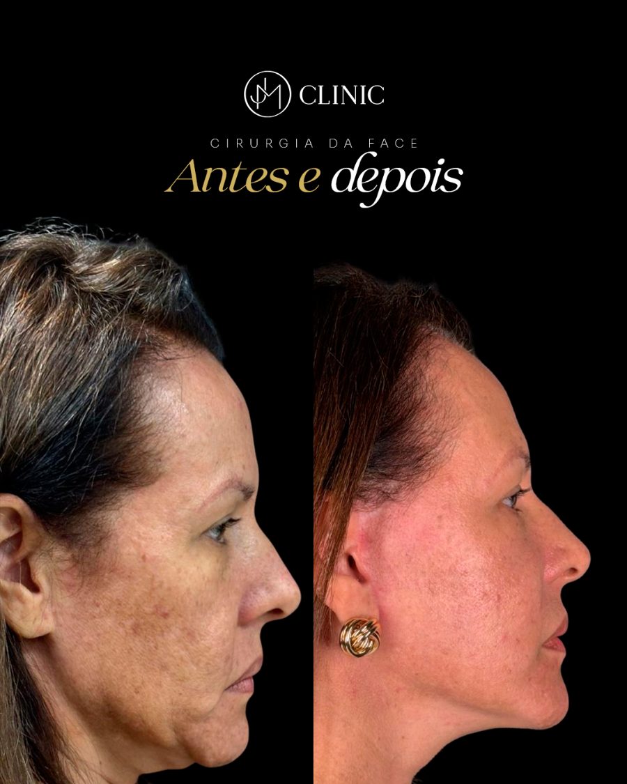 Antes e depois de cirurgia da face, JM Clinic