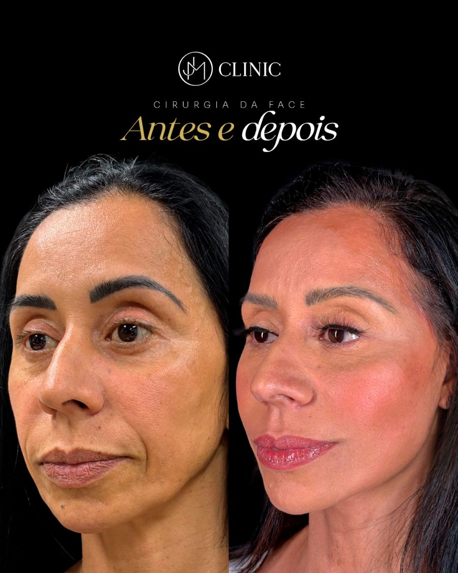 Antes e depois de cirurgia da face, JM Clinic