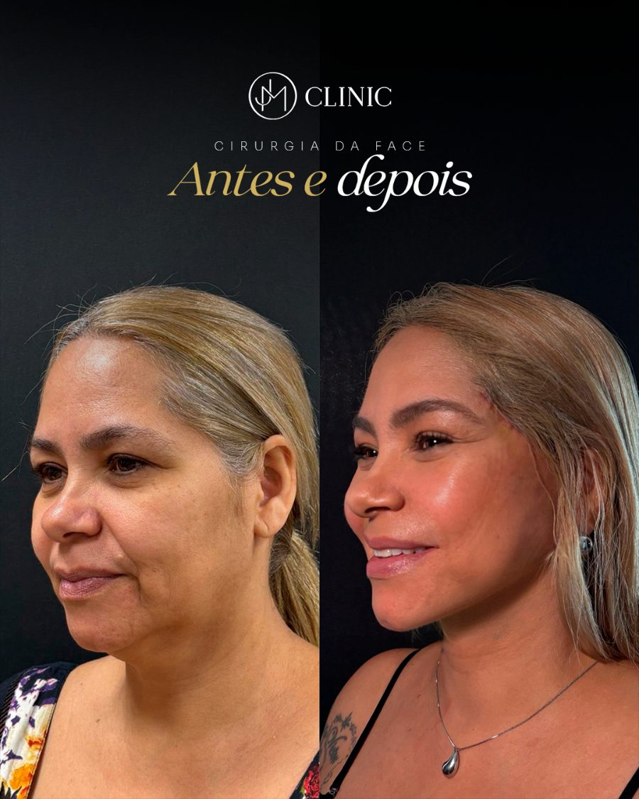 Antes e depois de cirurgia da face, JM Clinic