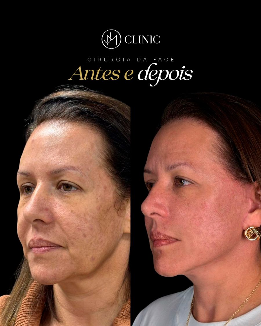 Antes e depois de cirurgia da face, JM Clinic