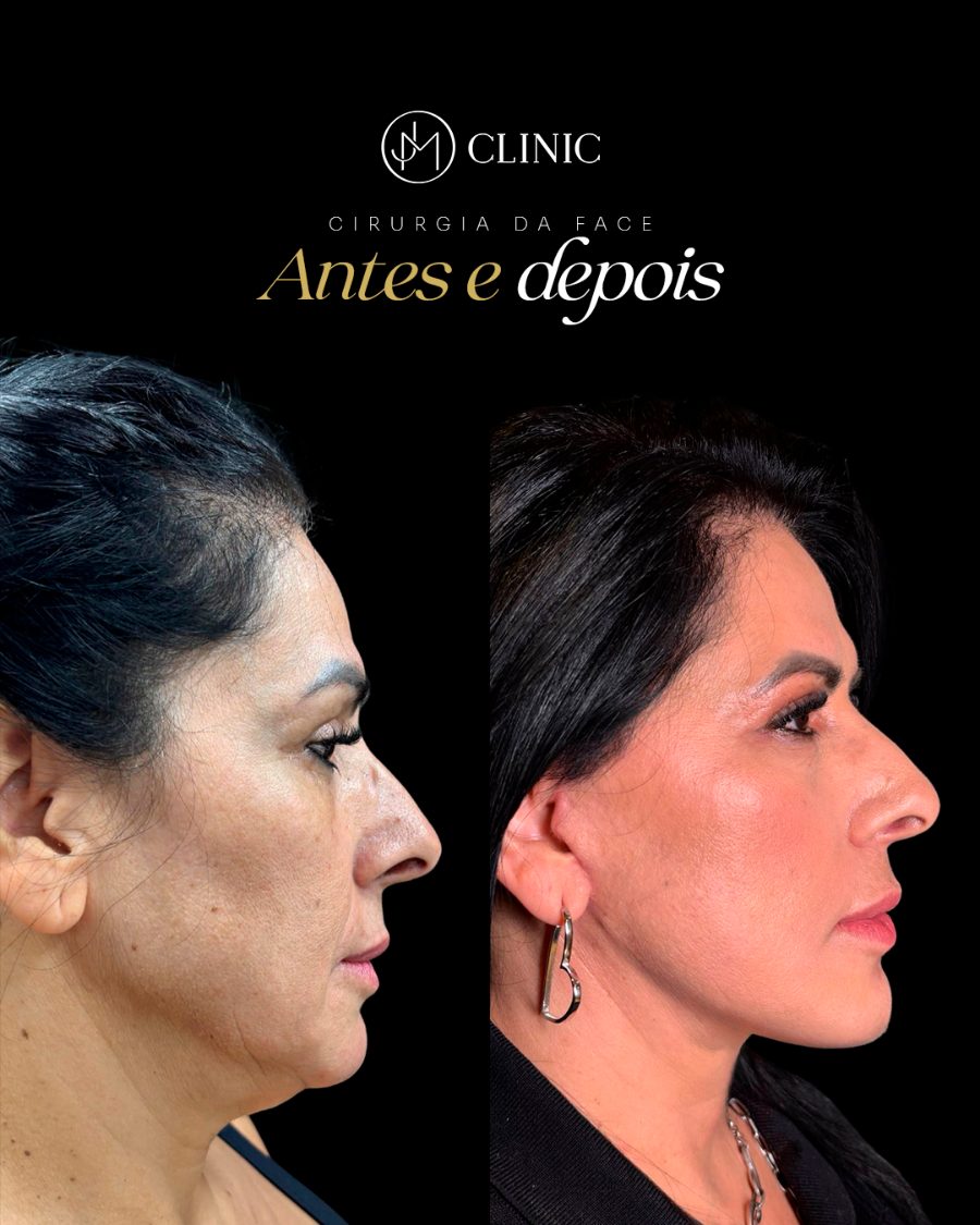 Antes e depois de cirurgia da face, JM Clinic