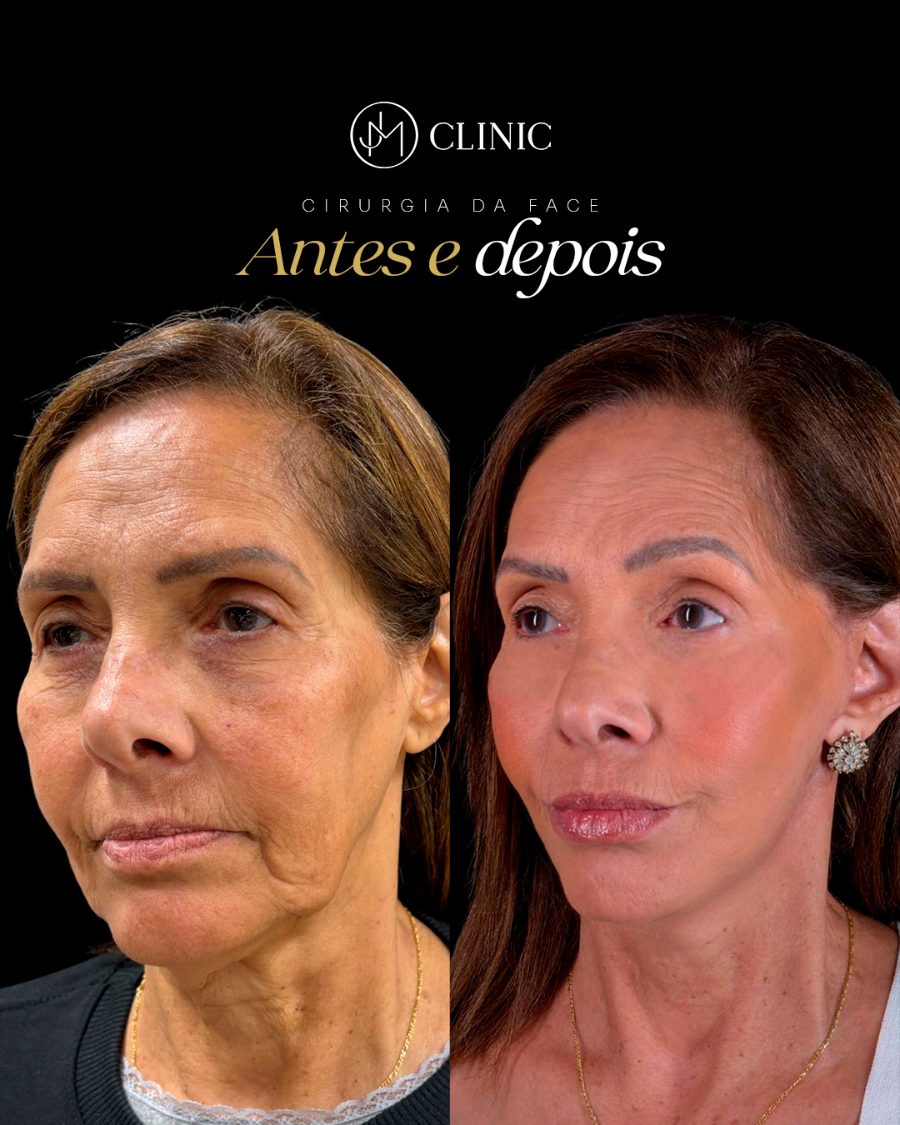 Antes e depois de cirurgia da face, JM Clinic